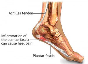 heel pain