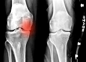 knee-OA unloader knee brace